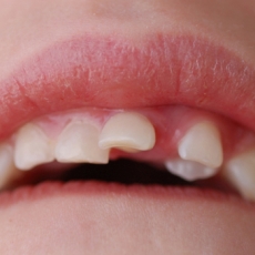 Dentinhos quebrados: o que fazer